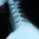 Xray showing the neck area of the spinal column